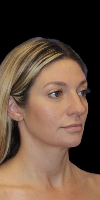 Primary Rhinoplasty Before & After Patient #825