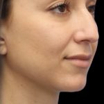 Primary Rhinoplasty Before & After Patient #855