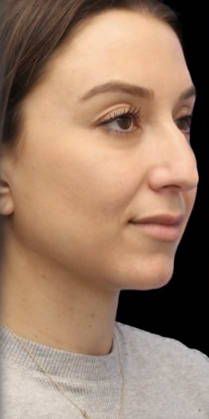 Primary Rhinoplasty Before & After Patient #855
