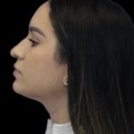 Primary Rhinoplasty Before & After Patient #856