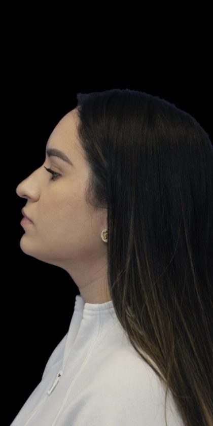 Primary Rhinoplasty Before & After Patient #856