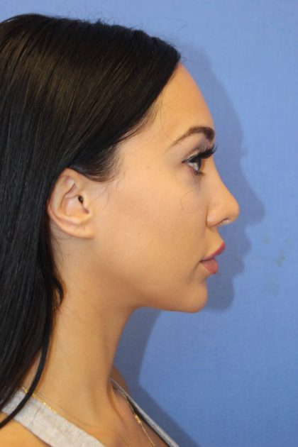 Revision Rhinoplasty Before & After Patient #875