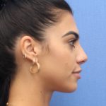 Revision Rhinoplasty Before & After Patient #876