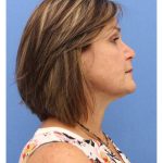 Revision Rhinoplasty Before & After Patient #877