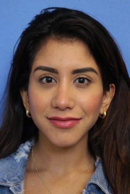 Primary Rhinoplasty Before & After Patient #744