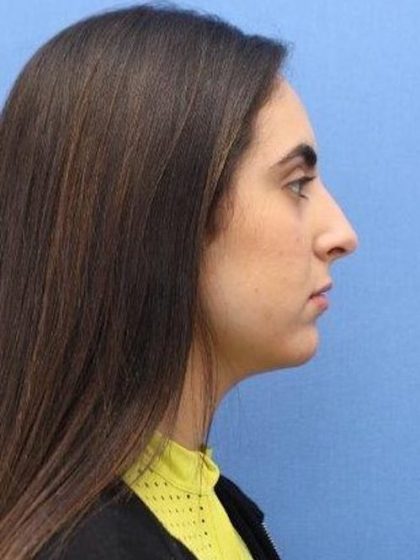 Primary Rhinoplasty Before & After Patient #774