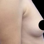 Breast Augmentation Before & After Patient #494