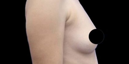 Breast Augmentation Before & After Patient #494