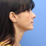 Primary Rhinoplasty Before & After Patient #777