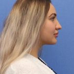 Primary Rhinoplasty Before & After Patient #778