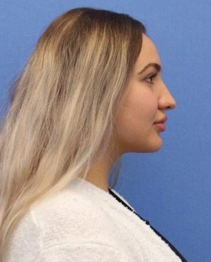 Primary Rhinoplasty Before & After Patient #778