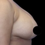 Breast Lift Before & After Patient #538