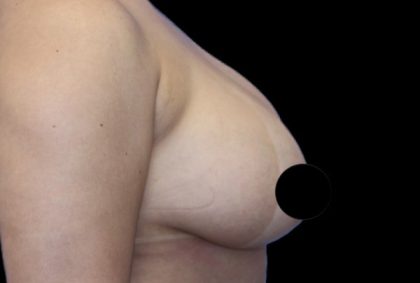 Breast Lift Before & After Patient #538