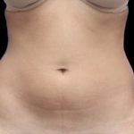 Liposuction/Liposculpture Before & After Patient #604