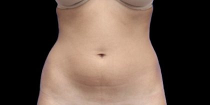Liposuction/Liposculpture Before & After Patient #604
