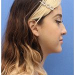 Primary Rhinoplasty Before & After Patient #740