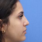 Primary Rhinoplasty Before & After Patient #741