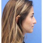 Primary Rhinoplasty Before & After Patient #742