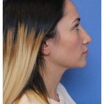 Primary Rhinoplasty Before & After Patient #775
