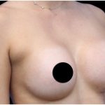 Breast Augmentation Before & After Patient #422