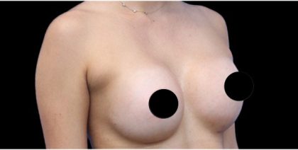 Breast Augmentation Before & After Patient #422