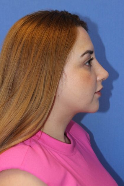 Primary Rhinoplasty Before & After Patient #776