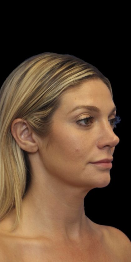 Primary Rhinoplasty Before & After Patient #825