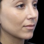 Primary Rhinoplasty Before & After Patient #855