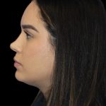 Primary Rhinoplasty Before & After Patient #856
