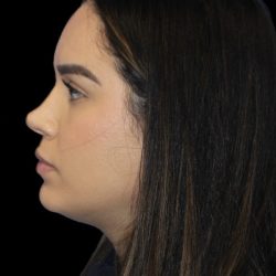 Primary Rhinoplasty Before & After Patient #856