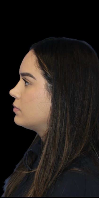 Primary Rhinoplasty Before & After Patient #856