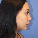 Revision Rhinoplasty Before & After Patient #875