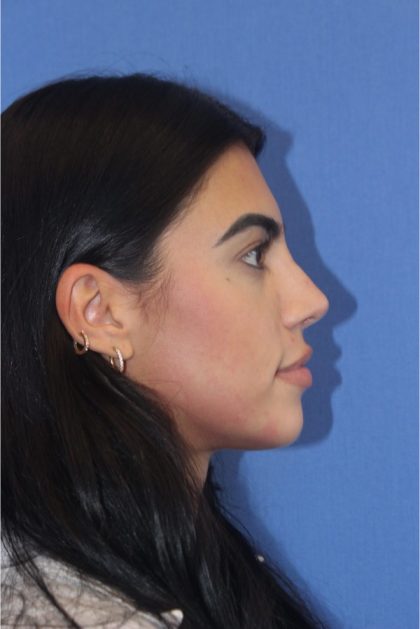 Revision Rhinoplasty Before & After Patient #876