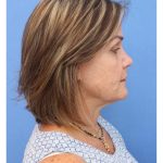 Revision Rhinoplasty Before & After Patient #877