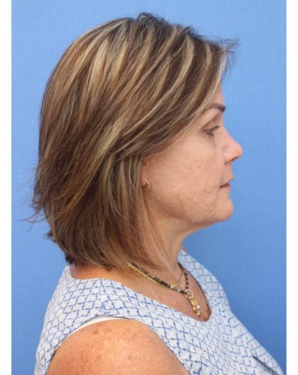 Revision Rhinoplasty Before & After Patient #877