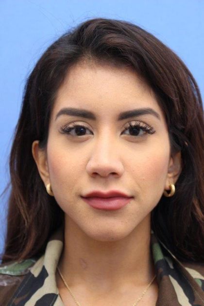 Primary Rhinoplasty Before & After Patient #744