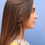 Primary Rhinoplasty Before & After Patient #774