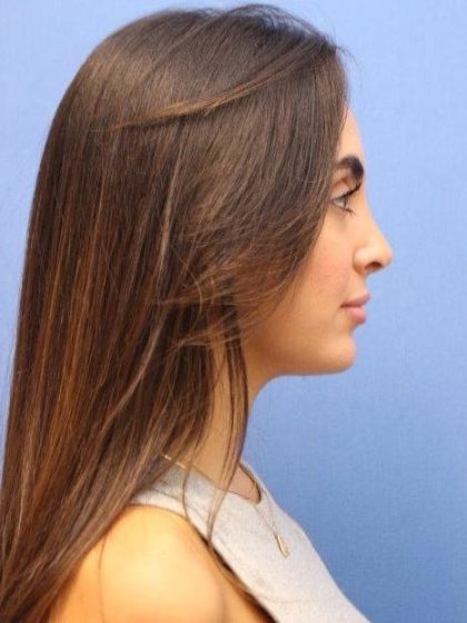 Primary Rhinoplasty Before & After Patient #774