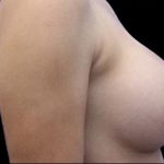 Breast Augmentation Before & After Patient #494