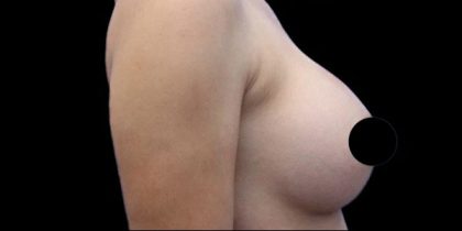 Breast Augmentation Before & After Patient #494
