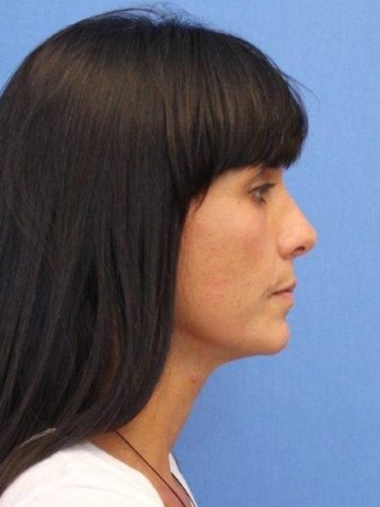 Primary Rhinoplasty Before & After Patient #777