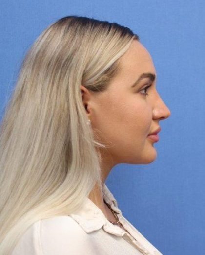Primary Rhinoplasty Before & After Patient #778