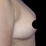 Breast Lift Before & After Patient #538