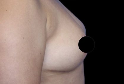 Breast Lift Before & After Patient #538