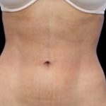 Liposuction/Liposculpture Before & After Patient #604