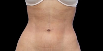 Liposuction/Liposculpture Before & After Patient #604