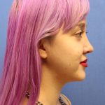Primary Rhinoplasty Before & After Patient #740