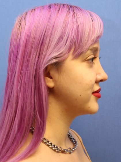 Primary Rhinoplasty Before & After Patient #740