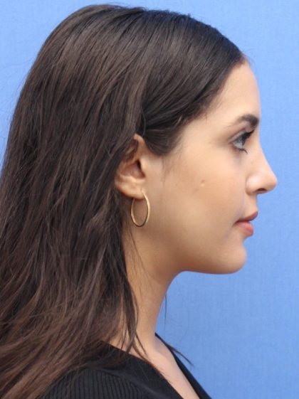 Primary Rhinoplasty Before & After Patient #741