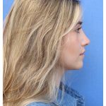 Primary Rhinoplasty Before & After Patient #742